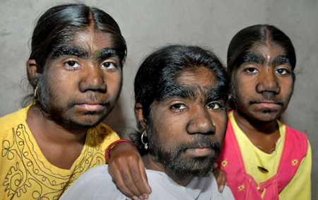 สามพี่น้องอินเดียหวั่นต้องเป็นโสด เหตุมีขนเต็มหน้า