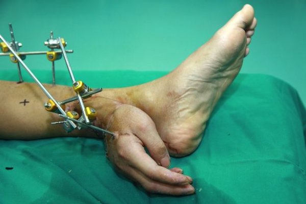 แพทย์จีนช่วยหนุ่มมือขาด ด้วยการปลูกถ่ายมือไว้ที่ข้อเท้า