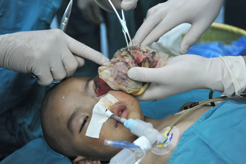 แพทย์จีน ช่วยเด็กป่วย เนื้องอกใหญ่ที่ดวงตา