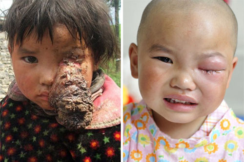 แพทย์จีน ช่วยเด็กป่วย เนื้องอกใหญ่ที่ดวงตา