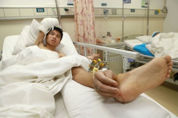 แพทย์จีนช่วยหนุ่มมือขาด ด้วยการปลูกถ่ายมือไว้ที่ข้อเท้า