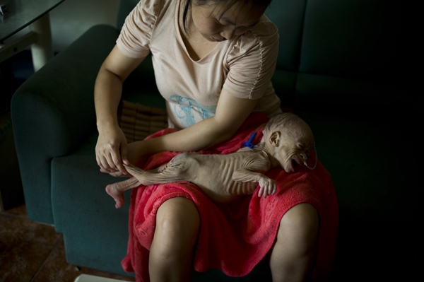 ทารกจีนป่วยแปลก ตัวเหี่ยวแขนขาลีบไม่ยอมโต