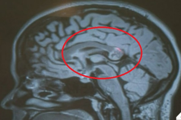 สยอง สาวปวดหัวโร่พบแพทย์ เจอแฝดปีศาจแฝงกายอยู่ในสมอง !!