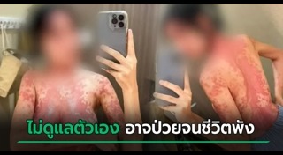 ผื่นคัน