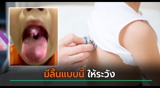 ผื่นคัน