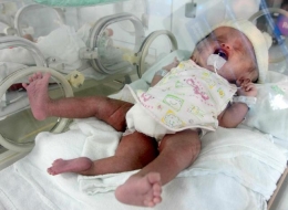 เด็ก 3 ขา