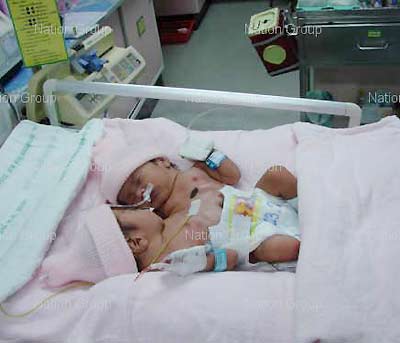 แฝดสยาม