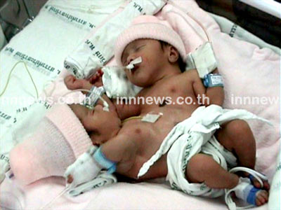 แฝดสยาม