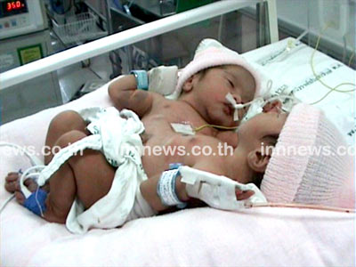 แฝดสยาม