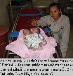 ทารก 2 หัว