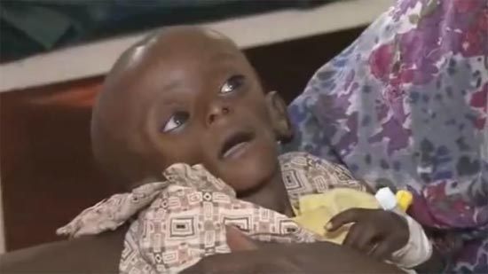 เผยภาพสุดสลด เด็กน้อยผอมโกรกใกล้ตายในเคนย่า