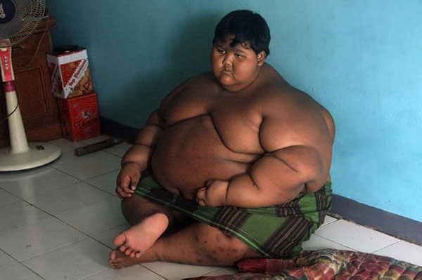 เด็กอินโดฯ น้ำหนักพุ่ง 190 กิโลกรัม