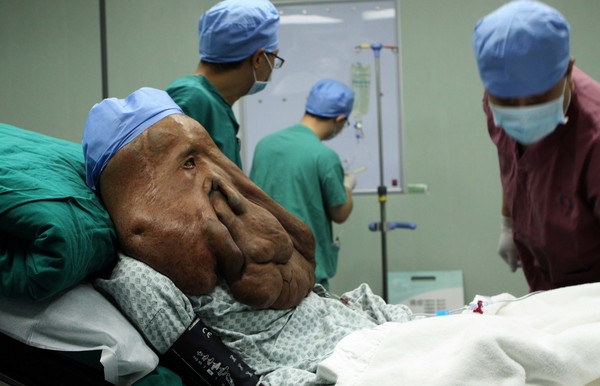หนุ่มจีนป่วยมนุษย์หน้าช้าง ผ่าตัดเนื้องอกออก 1 กก.