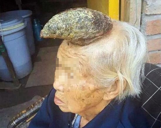 หญิงชราชาวจีนมีเขางอกกลางหัว