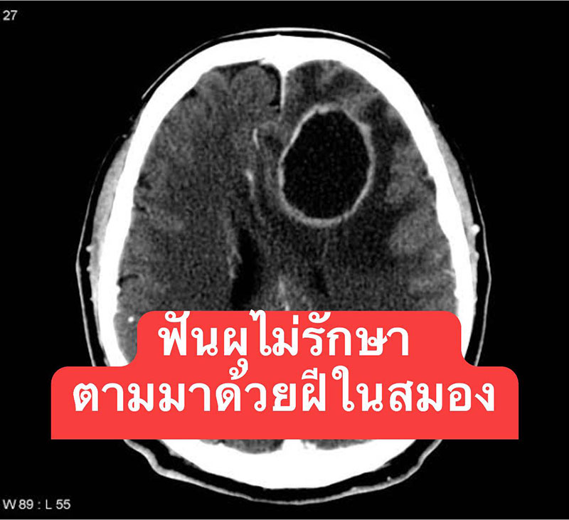 ฝันผุไม่รักษา
