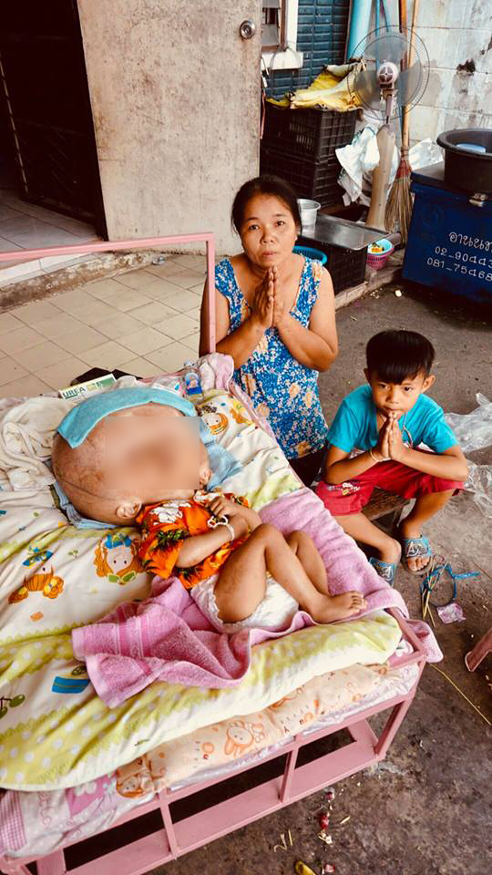 โรคหัวบาตร