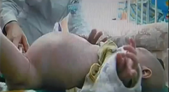 แพทย์จีนผ่าตัดแฝดกาฝากเติบโตในท้องเด็กชายวัย 2 ขวบ 