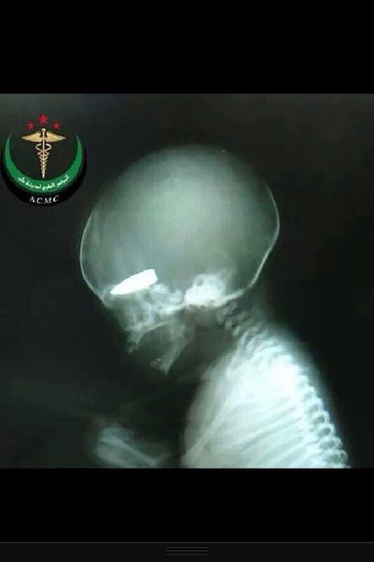 แพทย์อังกฤษเผย กลุ่มก่อการร้ายซีเรียยิงผู้หญิงท้อง แลกกับบุหรี่