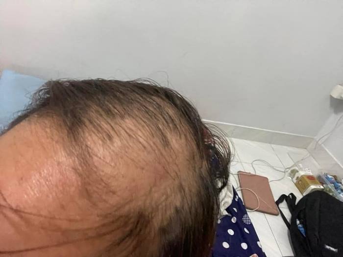 ร้านทำผม จ่อฟ้องกลับ ลูกค้ายืดผมแต่ผมร่วงหมดหัว