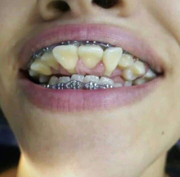 จัดฟันเถื่อน