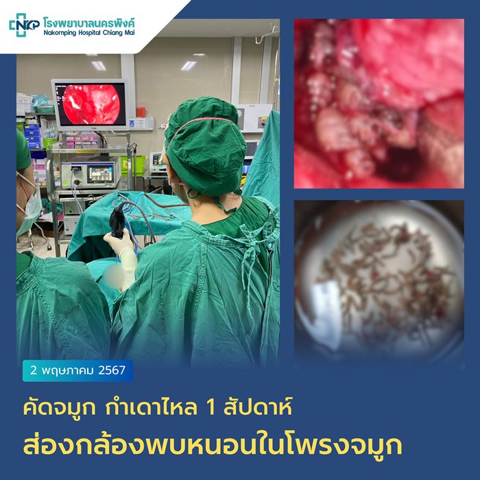 หนอนในโพรงจมูก
