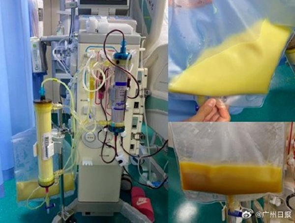Một phụ nữ 27 tuổi bị đau bụng dữ dội và rất sốc khi phát hiện máu mình có màu trắng đục. Cô tiết lộ nguyên nhân là do thức uống yêu thích của mình.