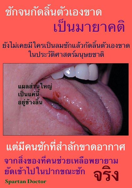 ชักจนกัดลิ้นขาด ไม่เคยมี