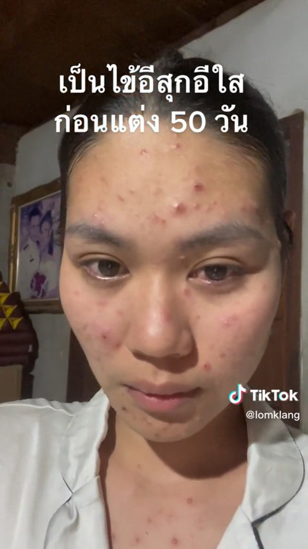 เจ้าสาวเป็นอีสุกอีใสก่อนแต่งงาน รอยแผลเป็นยับ เจอช่างแต่งหน้าเทพ