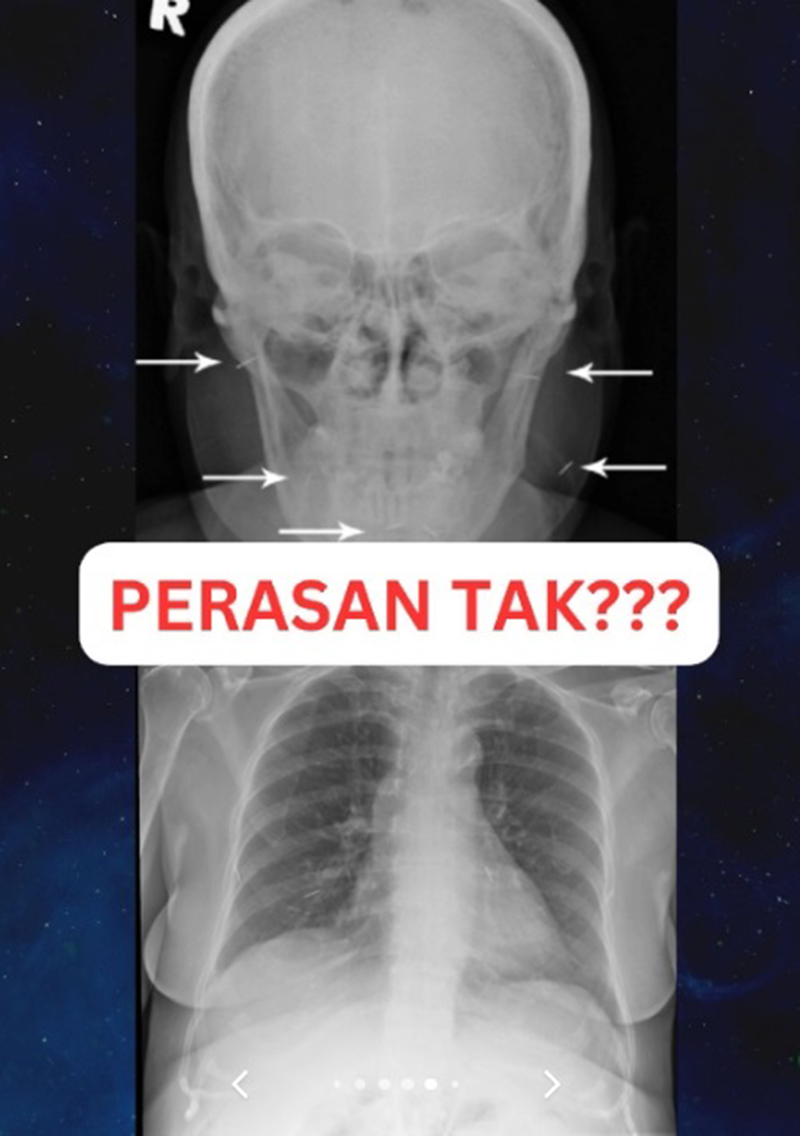 หญิงป่วยเข้า รพ. แพทย์หลอนเจอเข็มเสน่ห์ฝังทั่ว ขอให้เอาออกก็ไม่ยอม ก่อนสิ้นลม
