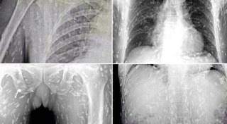 พยาธิไชสมอง