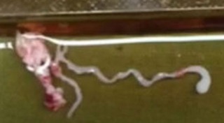 พยาธิไชสมอง