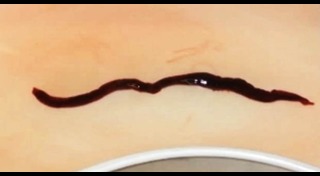 พยาธิไชสมอง