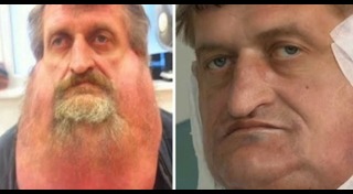 วิธีกำจัดขนบนใบหน้า