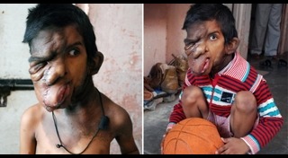 วิธีกำจัดขนบนใบหน้า