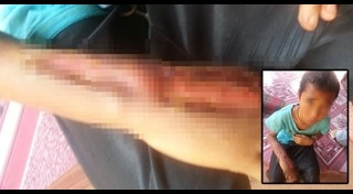 เด็กถูกงูกัด