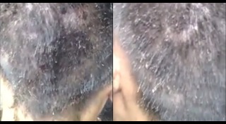 วิธีกำจัดเหา