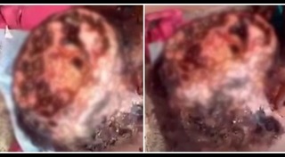 เชื้อราบนหนังศีรษะ