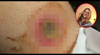 แมงมุมกัด