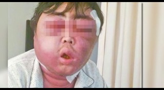 หน้าบวม