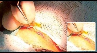 พยาธิในตา