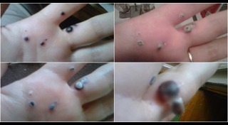 มะเร็งผิวหนัง