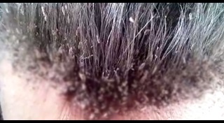 วิธีกำจัดเหา