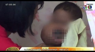 มะเร็งผิวหนัง