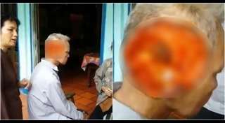 พยาธิไชสมอง