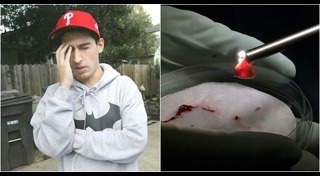 พยาธิในสมอง