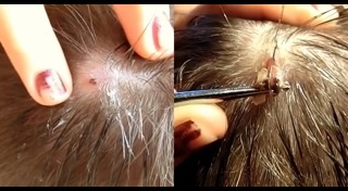 เชื้อราบนหนังศีรษะ