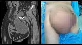 ไส้เลื่อน