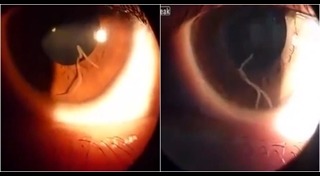 พยาธิในตา