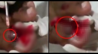 เชื้อราบนหนังศีรษะ