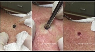 วิธีรักษาหลุมสิว